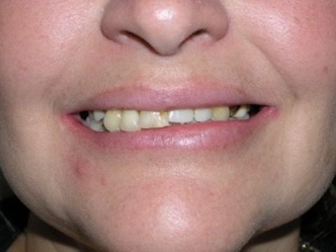 Veneers Gallery Before & After Image