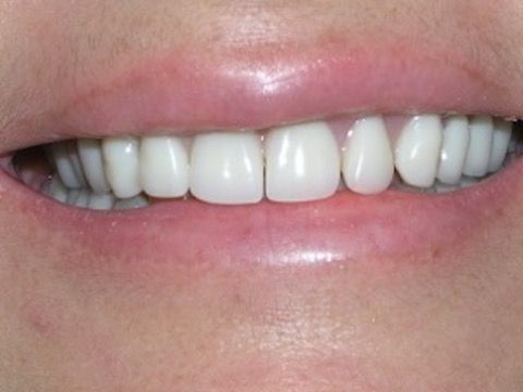 Veneers Gallery Before & After Image